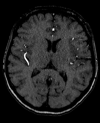 File:Berry aneurysm of the terminal internal carotid artery (Radiopaedia 88286-104918 Axial TOF 136).jpg