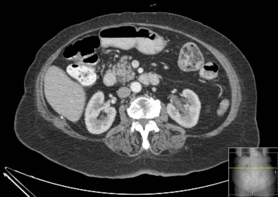 File:Bicameral celiacomesenteric aneurysm (Radiopaedia 55766-62327 A 27).jpg