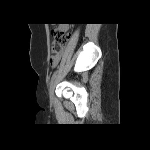 File:Bicornuate uterus- on MRI (Radiopaedia 49206-54296 A 3).jpg