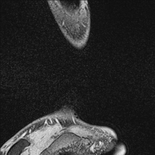 Bilateral Achilles tendon complete tear (Radiopaedia 81344-95051 Sagittal WE - Left 19).jpg