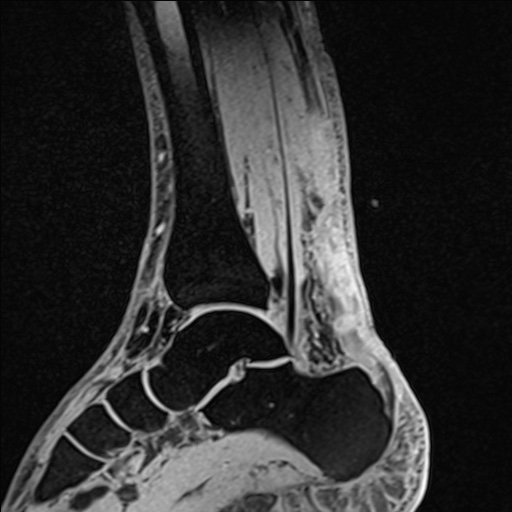 Bilateral Achilles tendon complete tear (Radiopaedia 81344-95051 Sagittal WE - Left 52).jpg