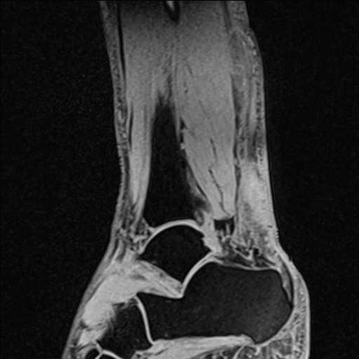 Bilateral Achilles tendon complete tear (Radiopaedia 81344-95051 Sagittal WE - Right 42).jpg