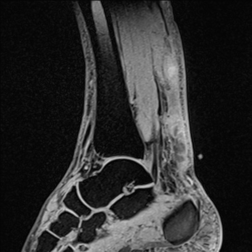 Bilateral Achilles tendon complete tear (Radiopaedia 81344-95051 Sagittal WE - Right 63).jpg