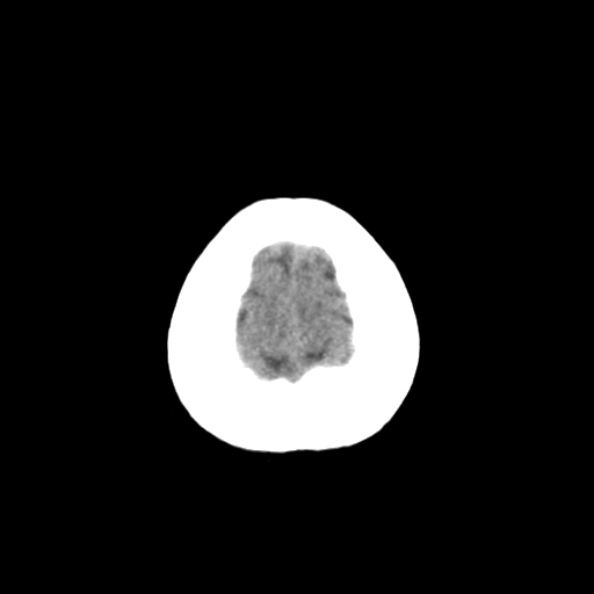 File:Bilateral PCA territory infarction - different ages (Radiopaedia 46200-50591 Axial non-contrast 23).jpg