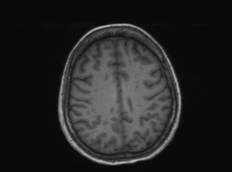File:Bilateral PCA territory infarction - different ages (Radiopaedia 46200-51784 Axial T1 182).jpg