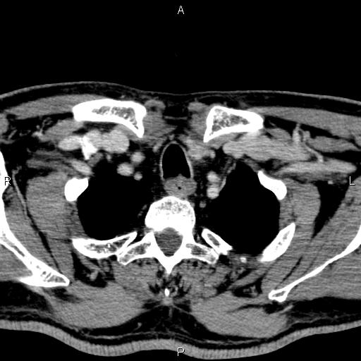 Bilateral Warthin tumors (Radiopaedia 84034-99263 Axial With contrast 63).jpg