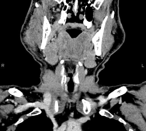 File:Bilateral Warthin tumors (Radiopaedia 84034-99263 C 18).jpg