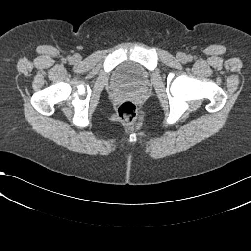 Bilateral acetabular protrusion with pincer type femoro-acetabular impingement (Radiopaedia 30134-30733 AXIAL SOFT THIN 65).jpg