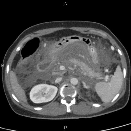 File:Bilateral adrenal gland hyperenhancement in pancreatitis (Radiopaedia 86642-102753 E 31).jpg