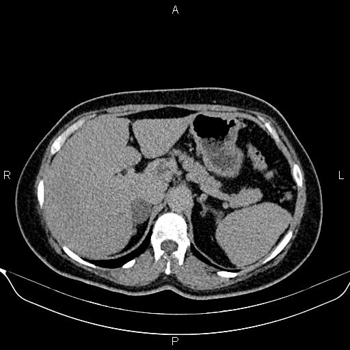 Bilateral benign adrenal adenomas (Radiopaedia 86912-103124 Axial C+ delayed 26).jpg
