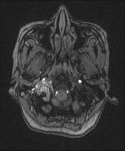 Bilateral carotid body tumors and right glomus jugulare tumor (Radiopaedia 20024-20060 Axial MRA 21).jpg
