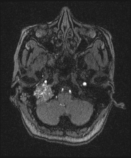 Bilateral carotid body tumors and right glomus jugulare tumor (Radiopaedia 20024-20060 Axial MRA 27).jpg
