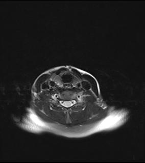 File:Bilateral carotid body tumors and right jugular paraganglioma (Radiopaedia 20024-20060 Axial 47).jpg