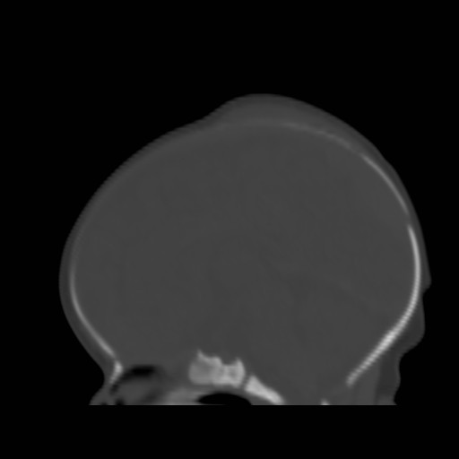 File:Bilateral cephalohematomas and subdural hematomas (Radiopaedia 26778-26929 Sagittal bone window 21).jpg