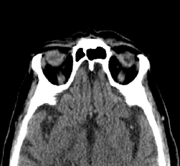 Bilateral ectopia lentis (Radiopaedia 89889-107013 Axial non-contrast 17).jpg