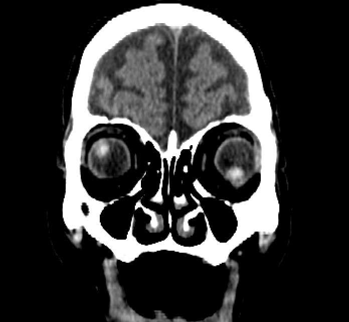 Bilateral ectopia lentis (Radiopaedia 89889-107013 Coronal non-contrast 45).jpg