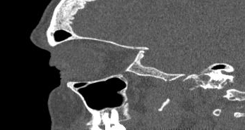 File:Bilateral ectopic infraorbital nerves (Radiopaedia 49006-54084 Sagittal 27).png