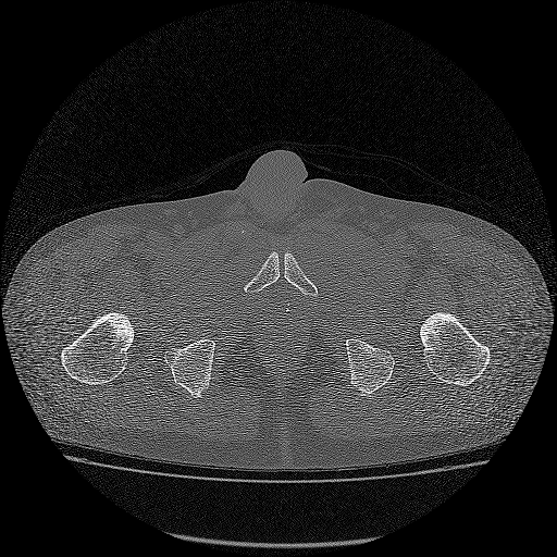Bilateral femoral neck stress fractures (Radiopaedia 28666-28954 Axial bone window 71).png
