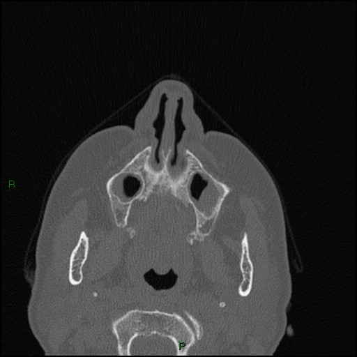 File:Bilateral frontal mucoceles (Radiopaedia 82352-96454 Axial bone window 227).jpg
