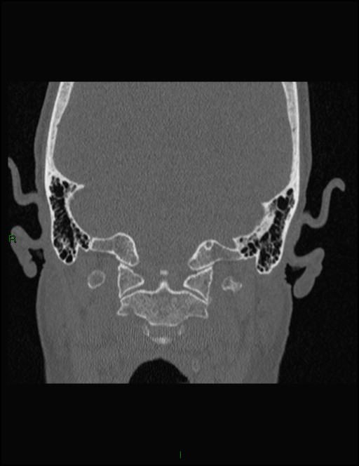 Bilateral frontal mucoceles (Radiopaedia 82352-96454 Coronal 352).jpg