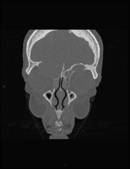 Bilateral frontal mucoceles (Radiopaedia 82352-96454 Coronal 90).jpg