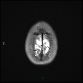 File:Bilateral frontal mucoceles (Radiopaedia 82352-96455 Axial T2 21).jpg