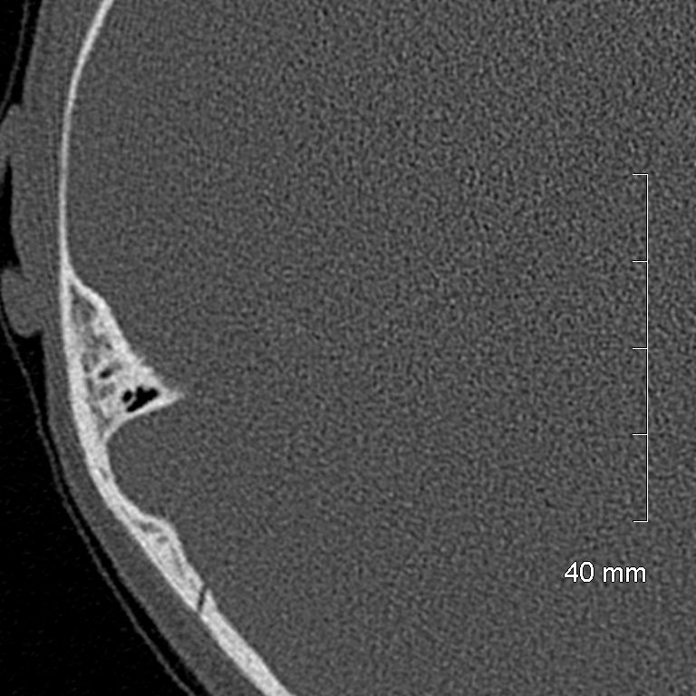 Bilateral grommets (Radiopaedia 47710-52404 Axial bone window 65).jpg