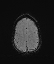 Bilateral mesial temporal polymicrogyria (Radiopaedia 76456-88181 Axial SWI 61).jpg