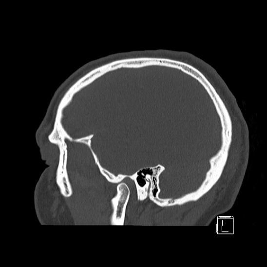 Bilateral occipital condyle fracture (type 2) (Radiopaedia 87675-104089 Sagittal bone window 11).jpg