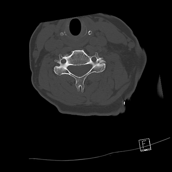 Bilateral occipital condyle fractures (type 3) (Radiopaedia 87672-104086 Axial bone window 49).jpg
