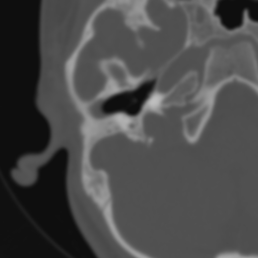 File:Bilateral otosclerosis (Radiopaedia 57237-64157 B 46).jpg