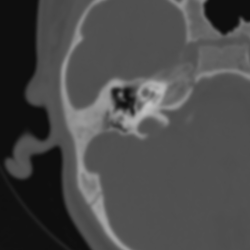 Bilateral otosclerosis (Radiopaedia 57237-64157 B 55).jpg