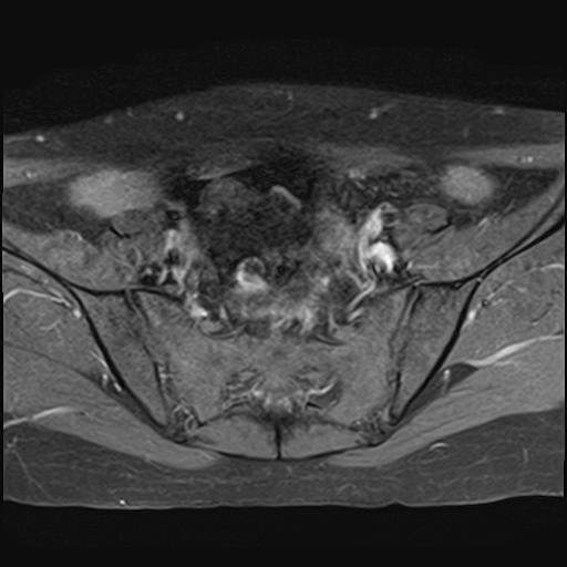 File:Bilateral ovarian endometriomas (Radiopaedia 87085-103347 Axial T1 C+ fat sat 5).jpg