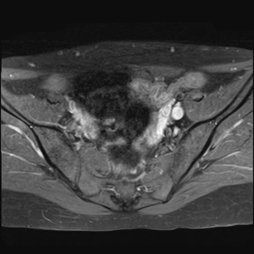 File:Bilateral ovarian endometriomas (Radiopaedia 87085-103347 Axial T1 C+ fat sat 7).jpg