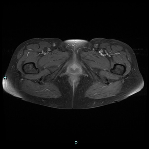 File:Bilateral ovarian fibroma (Radiopaedia 44568-48293 Axial T1 C+ fat sat 31).jpg