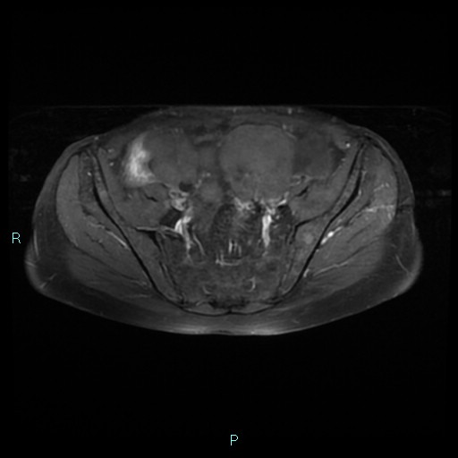 File:Bilateral ovarian fibroma (Radiopaedia 44568-48293 Axial T1 C+ fat sat 9).jpg