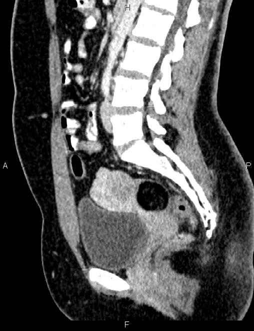 Bilateral ovarian teratoma (Radiopaedia 83131-97503 D 65).jpg