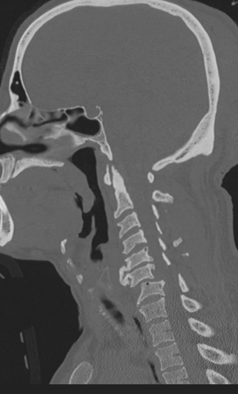 Bilateral perched facet joint (Radiopaedia 63149-71669 Sagittal bone window 25).jpg