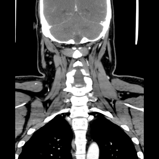 File:Bilateral peritonsillar abscess (Radiopaedia 85065-100610 Coronal 55).jpg
