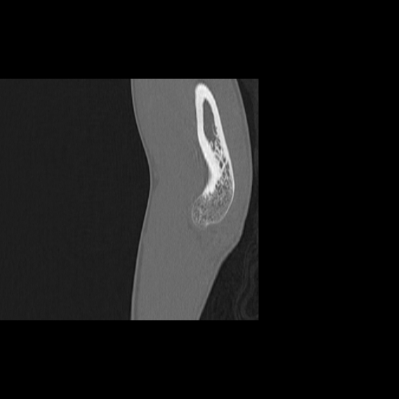 File:Bilateral proximal radioulnar synostosis (Radiopaedia 66532-75812 B 6).jpg