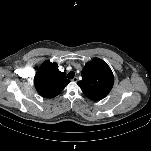 Bilateral pulmonary AVM (Radiopaedia 83134-97505 A 14).jpg