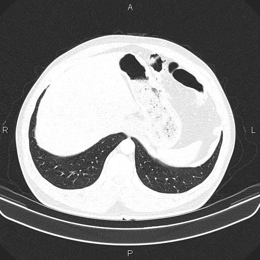 File:Bilateral pulmonary AVM (Radiopaedia 83134-97505 Axial lung window 66).jpg
