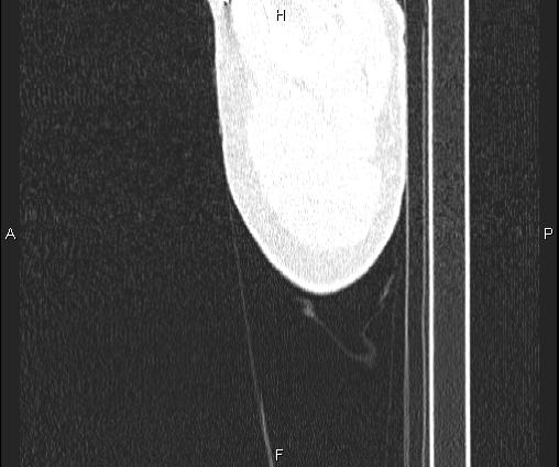 Bilateral pulmonary AVM (Radiopaedia 83134-97505 Sagittal lung window 4).jpg