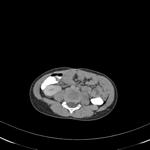 File:Bilateral renal malrotation (Radiopaedia 30901-31606 A 11).jpg