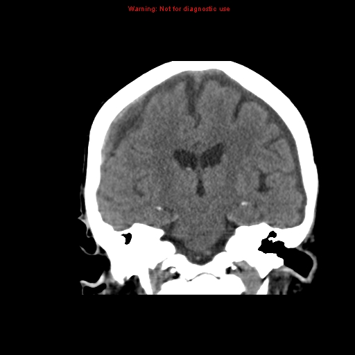 File:Bilateral subdural hemorrhage (Radiopaedia 8819-9620 Coronal non-contrast 8).jpg