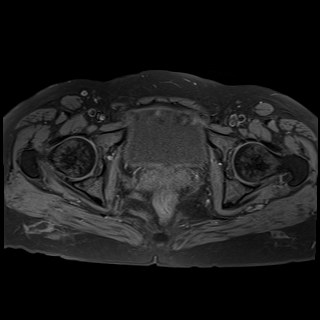 Bilateral tubo-ovarian abscesses (Radiopaedia 58635-65829 Axial T1 fat sat 35).jpg