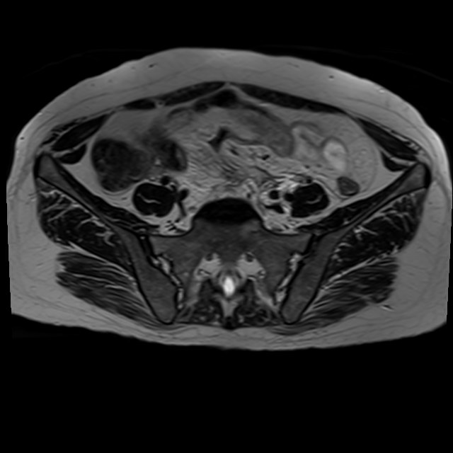 Bilateral tubo-ovarian abscesses (Radiopaedia 58635-65829 Axial T2 7).jpg
