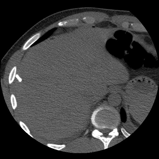 File:Bile leak from liver traumatic laceration (Radiopaedia 63463-72077 Axial Biliscopin 18).jpg