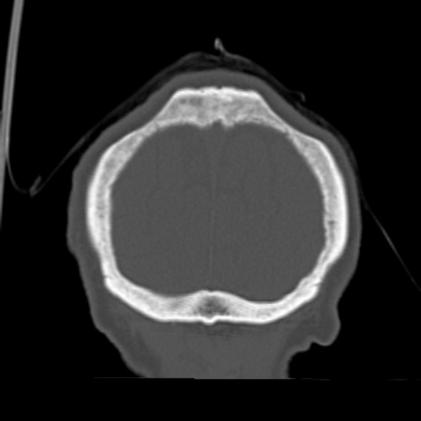 Biparietal osteodystrophy (Radiopaedia 46109-50463 Coronal bone window 95).jpg