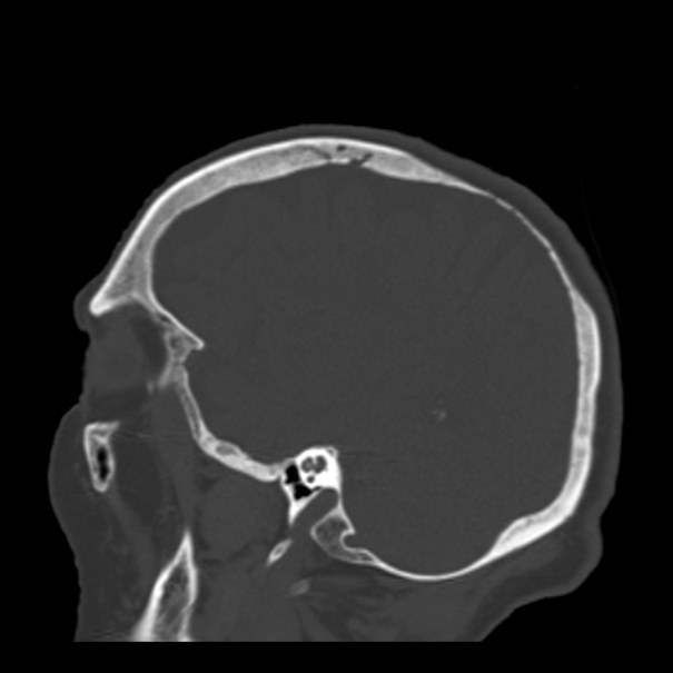 Biparietal osteodystrophy (Radiopaedia 46109-50463 Sagittal bone window 30).jpg
